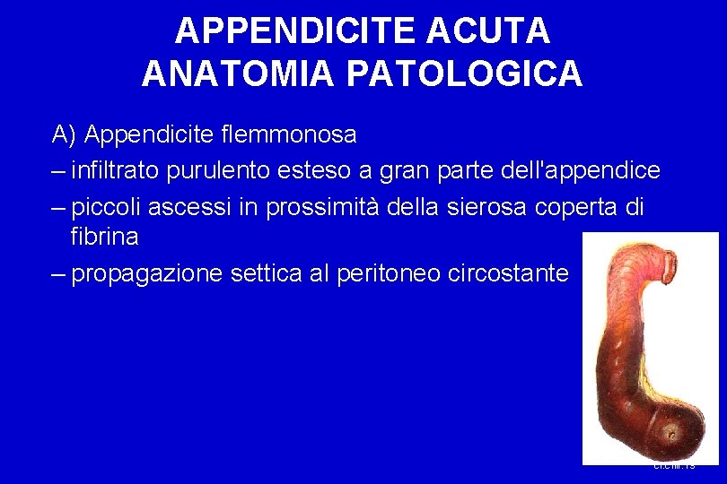 APPENDICITE ACUTA ANATOMIA PATOLOGICA A) Appendicite flemmonosa – infiltrato purulento esteso a gran parte