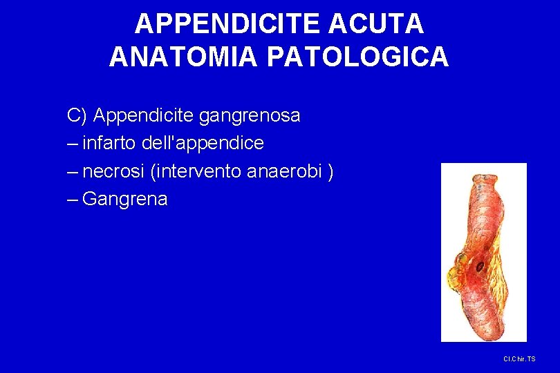 APPENDICITE ACUTA ANATOMIA PATOLOGICA C) Appendicite gangrenosa – infarto dell'appendice – necrosi (intervento anaerobi