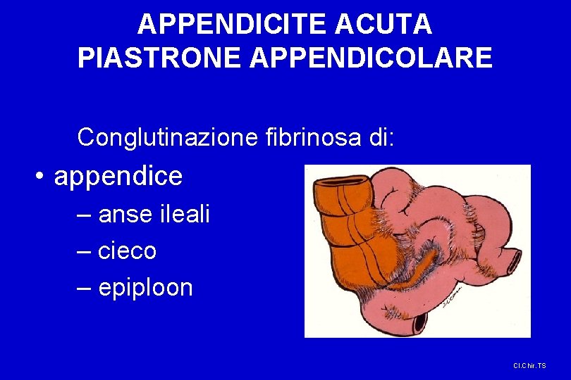 APPENDICITE ACUTA PIASTRONE APPENDICOLARE Conglutinazione fibrinosa di: • appendice – anse ileali – cieco