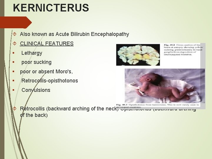 KERNICTERUS Also known as Acute Bilirubin Encephalopathy CLINICAL FEATURES § Lethargy § poor sucking