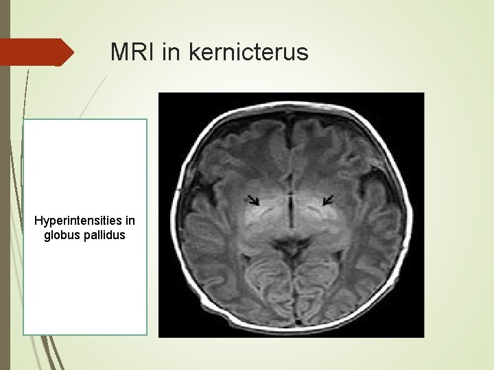 MRI in kernicterus Hyperintensities in globus pallidus 