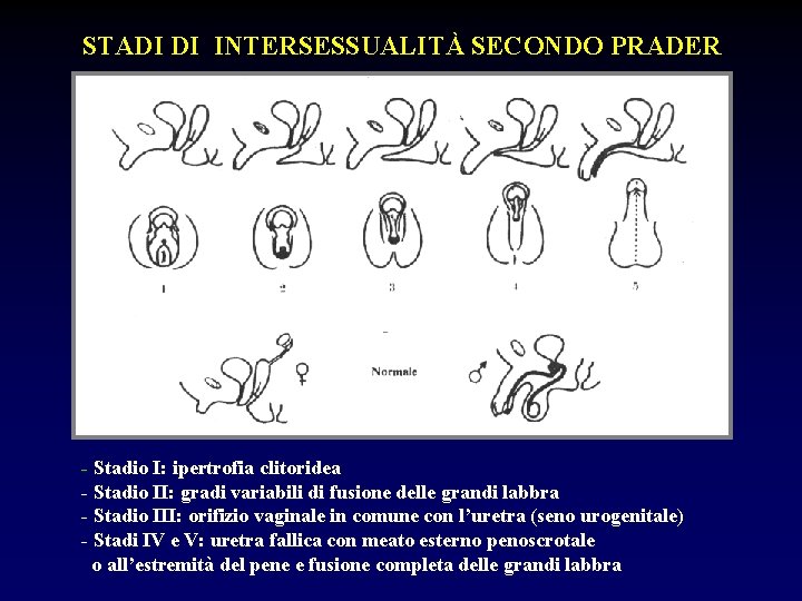 STADI DI INTERSESSUALITÀ SECONDO PRADER - Stadio I: ipertrofia clitoridea - Stadio II: gradi