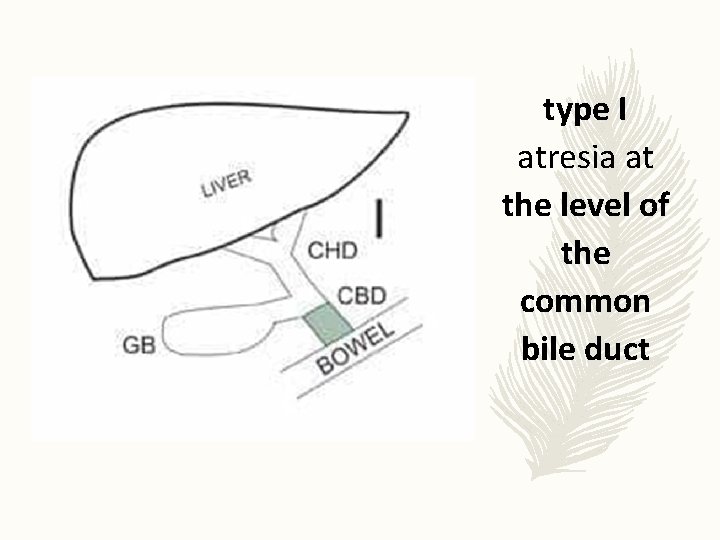 type I atresia at the level of the common bile duct 