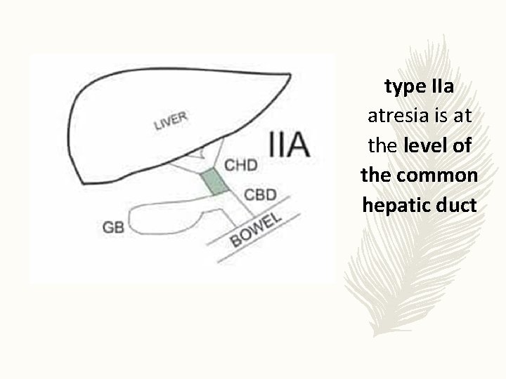 type IIa atresia is at the level of the common hepatic duct 