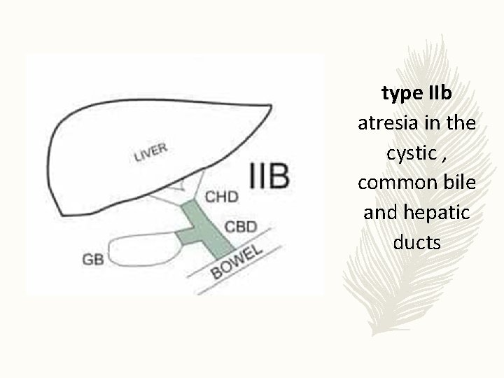 type IIb atresia in the cystic , common bile and hepatic ducts 