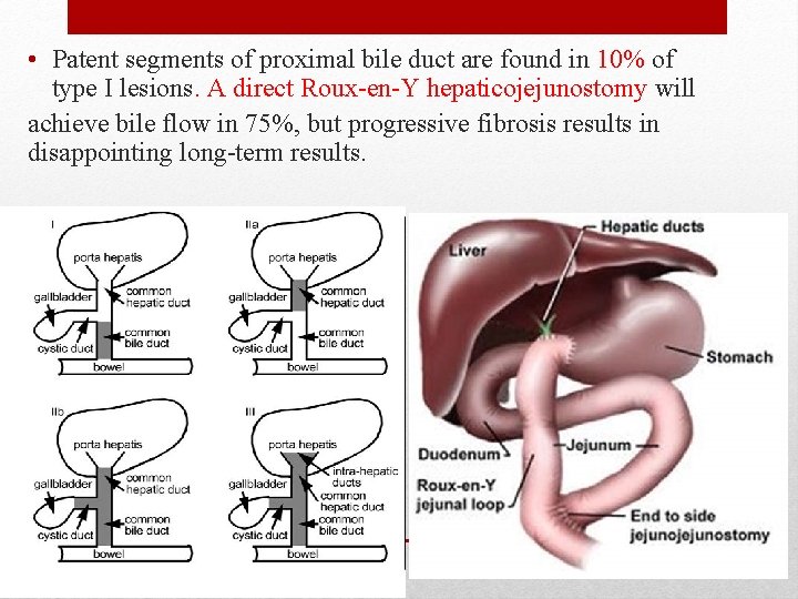  • Patent segments of proximal bile duct are found in 10% of type