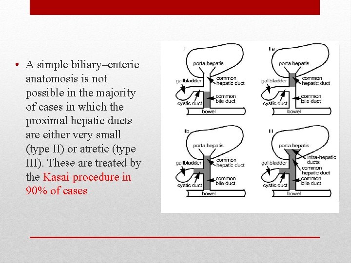  • A simple biliary–enteric anatomosis is not possible in the majority of cases