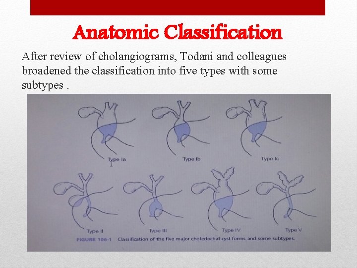 Anatomic Classification After review of cholangiograms, Todani and colleagues broadened the classification into five