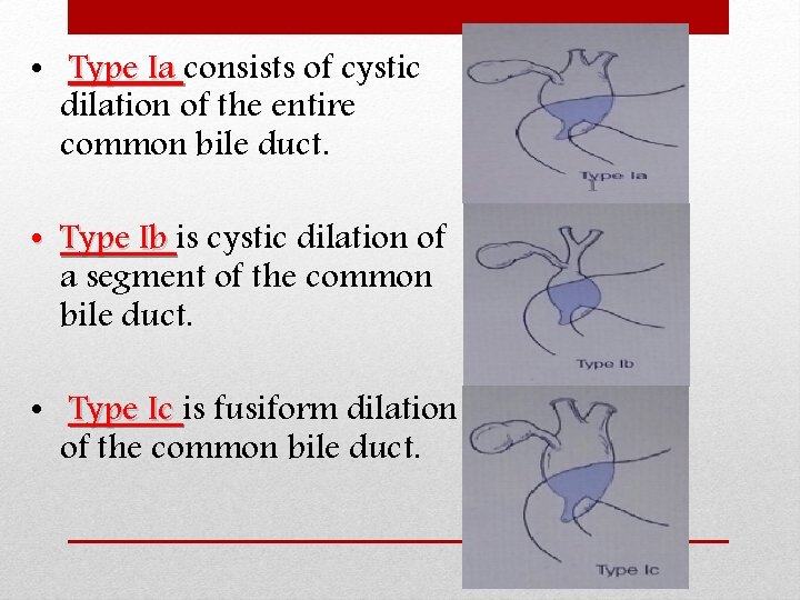  • Type Ia consists of cystic dilation of the entire common bile duct.