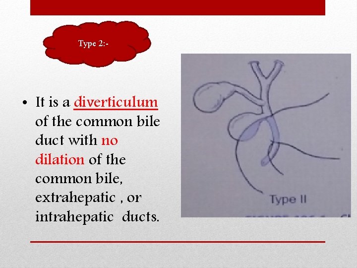 Type 2: - • It is a diverticulum of the common bile duct with