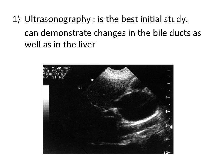 1) Ultrasonography : is the best initial study. can demonstrate changes in the bile