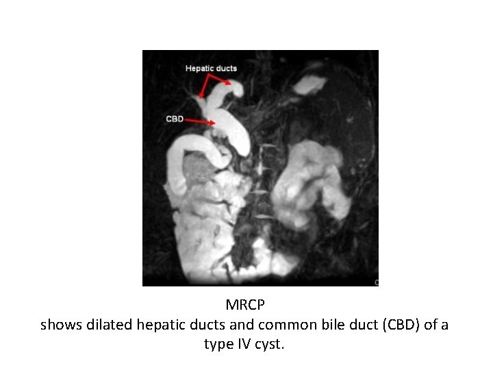 MRCP shows dilated hepatic ducts and common bile duct (CBD) of a type IV