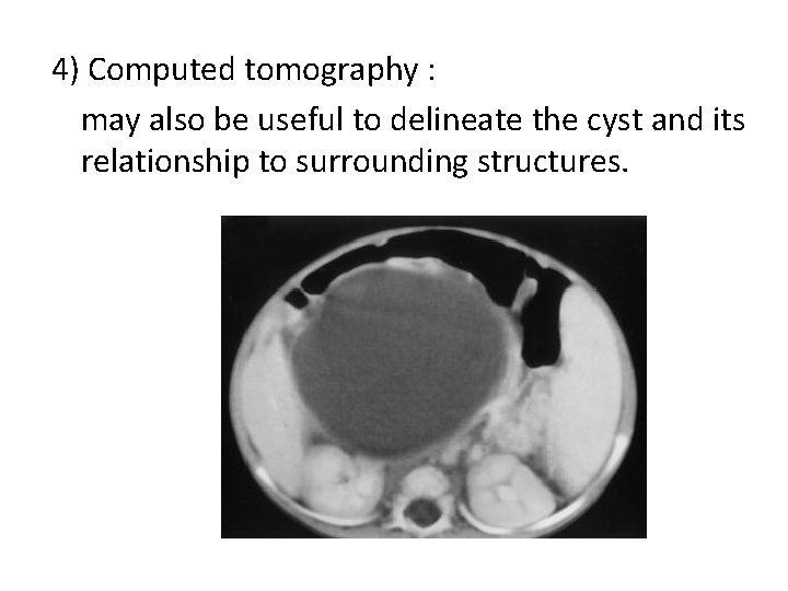 4) Computed tomography : may also be useful to delineate the cyst and its