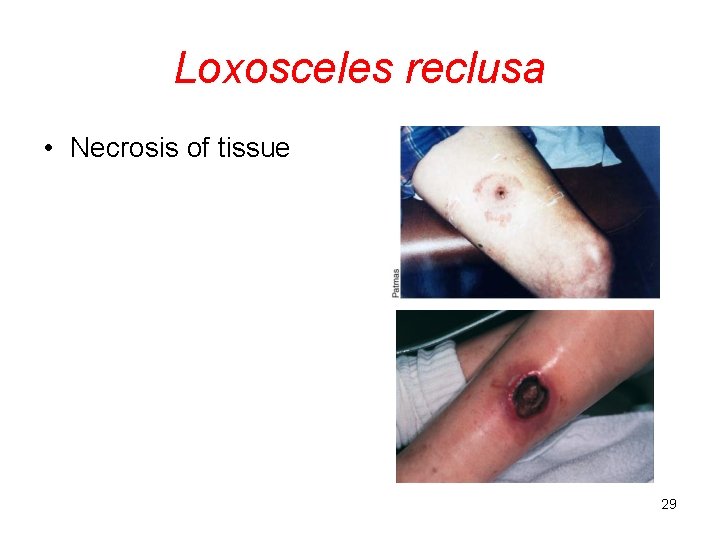 Loxosceles reclusa • Necrosis of tissue 29 