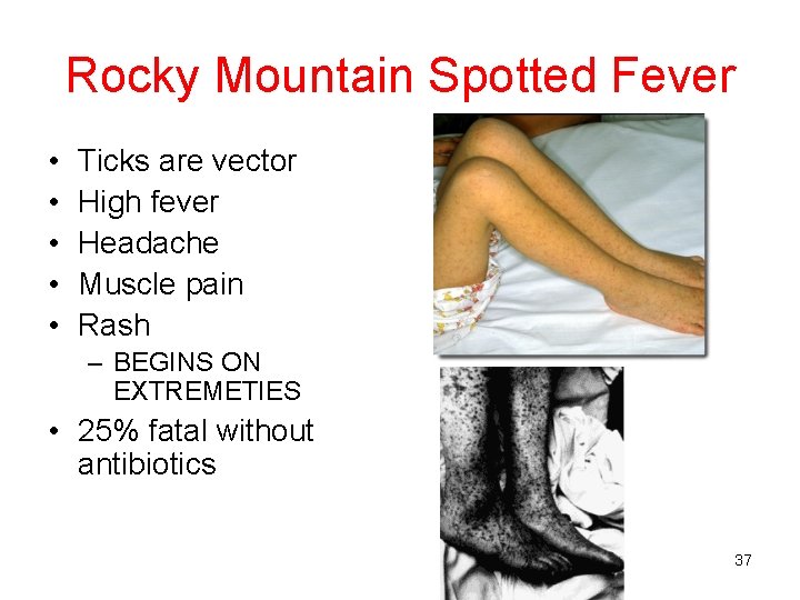 Rocky Mountain Spotted Fever • • • Ticks are vector High fever Headache Muscle