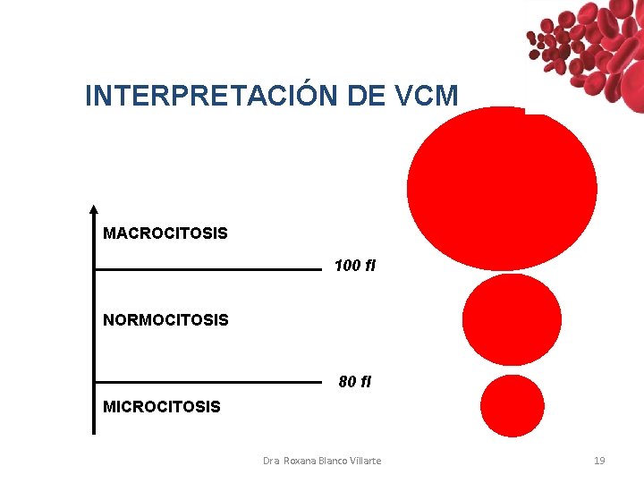 INTERPRETACIÓN DE VCM MACROCITOSIS 100 fl NORMOCITOSIS 80 fl MICROCITOSIS Dra. Roxana Blanco Villarte