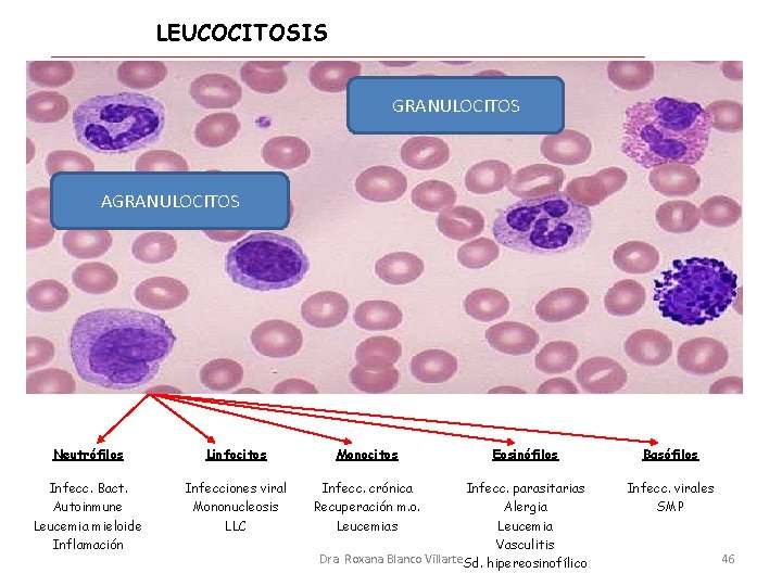 LEUCOCITOSIS GRANULOCITOS AGRANULOCITOS Neutrófilos Linfocitos Monocitos Infecc. Bact. Autoinmune Leucemia mieloide Inflamación Infecciones viral