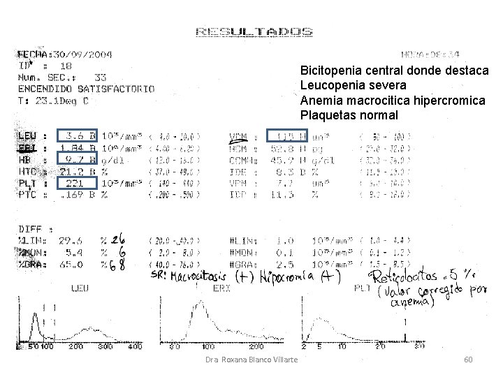 Bicitopenia central donde destaca Leucopenia severa Anemia macrocitica hipercromica Plaquetas normal Dra. Roxana Blanco