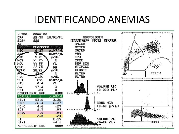 IDENTIFICANDO ANEMIAS Dra. Roxana Blanco Villarte 66 