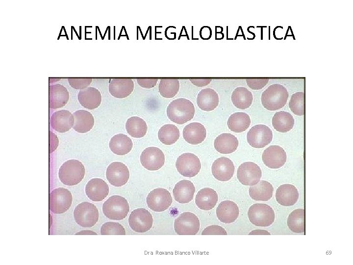 ANEMIA MEGALOBLASTICA Dra. Roxana Blanco Villarte 69 