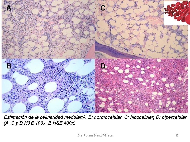 Estimación de la celularidad medular: A, B: normocelular, C: hipocelular, D: hipercelular (A, C
