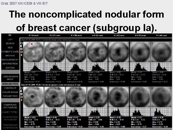 Graz 2007 XIII ICEBI & VIII EIT The noncomplicated nodular form of breast cancer