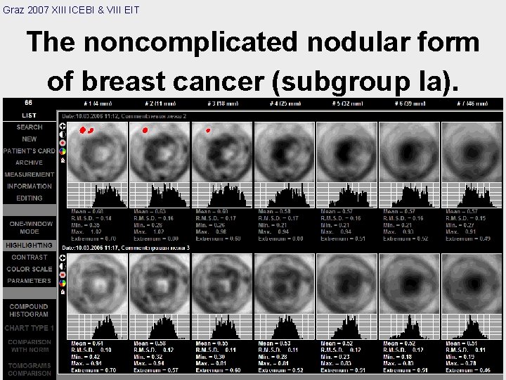 Graz 2007 XIII ICEBI & VIII EIT The noncomplicated nodular form of breast cancer