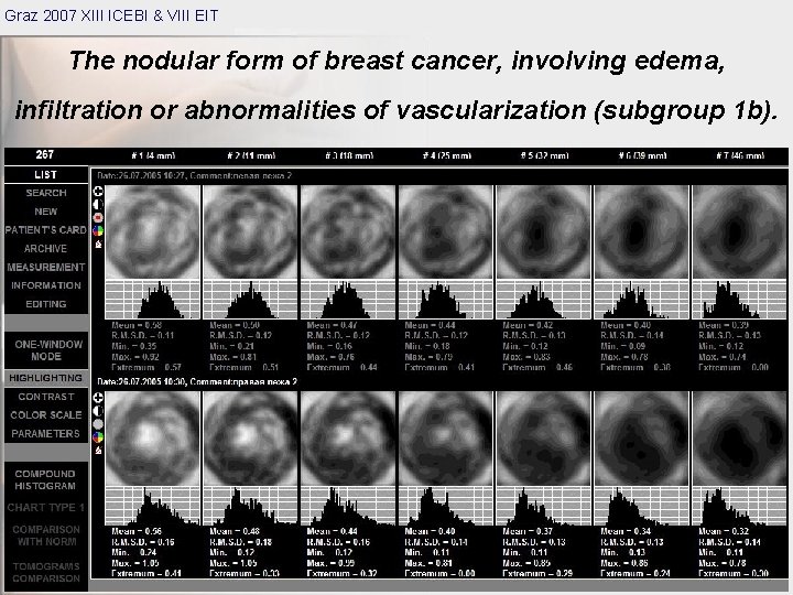 Graz 2007 XIII ICEBI & VIII EIT The nodular form of breast cancer, involving