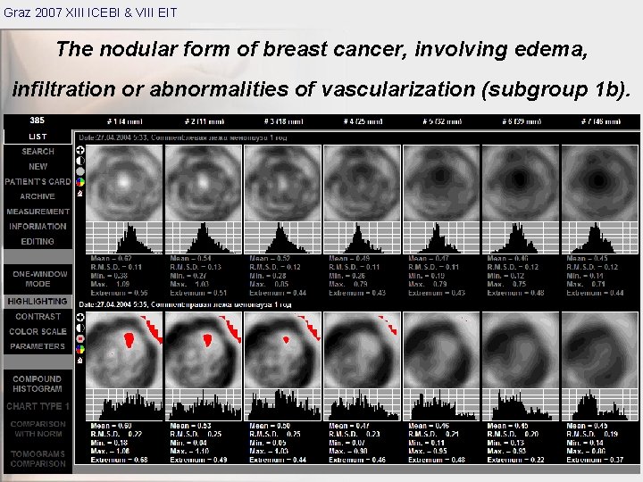 Graz 2007 XIII ICEBI & VIII EIT The nodular form of breast cancer, involving
