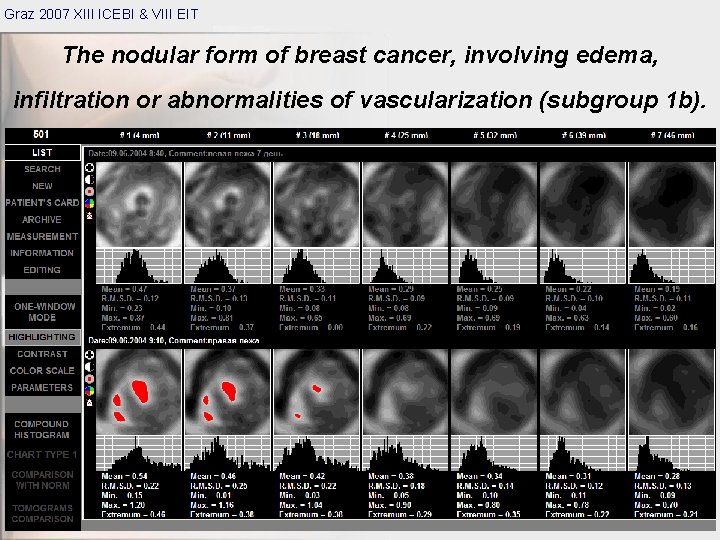 Graz 2007 XIII ICEBI & VIII EIT The nodular form of breast cancer, involving