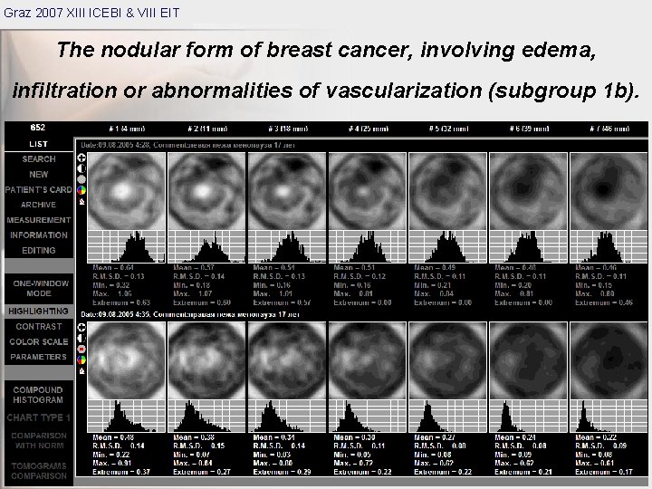 Graz 2007 XIII ICEBI & VIII EIT The nodular form of breast cancer, involving