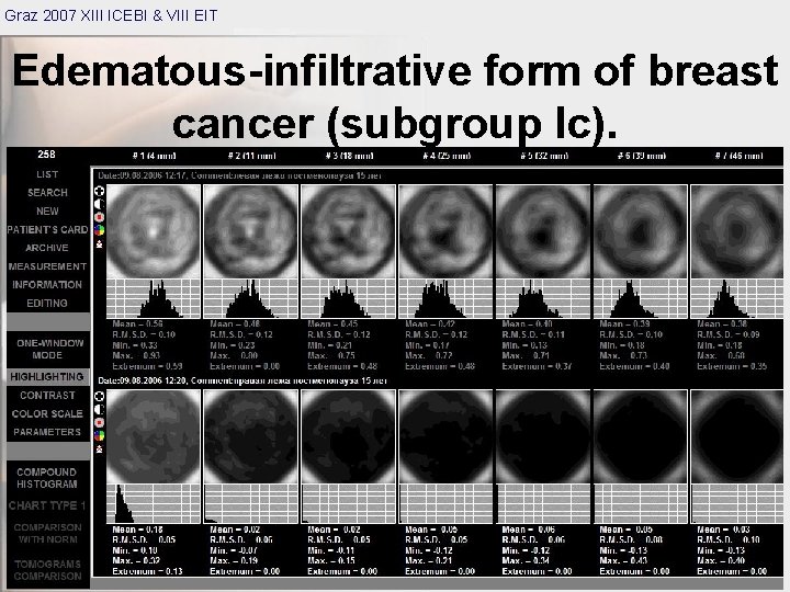 Graz 2007 XIII ICEBI & VIII EIT Edematous-infiltrative form of breast cancer (subgroup Ic).