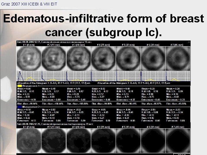 Graz 2007 XIII ICEBI & VIII EIT Edematous-infiltrative form of breast cancer (subgroup Ic).
