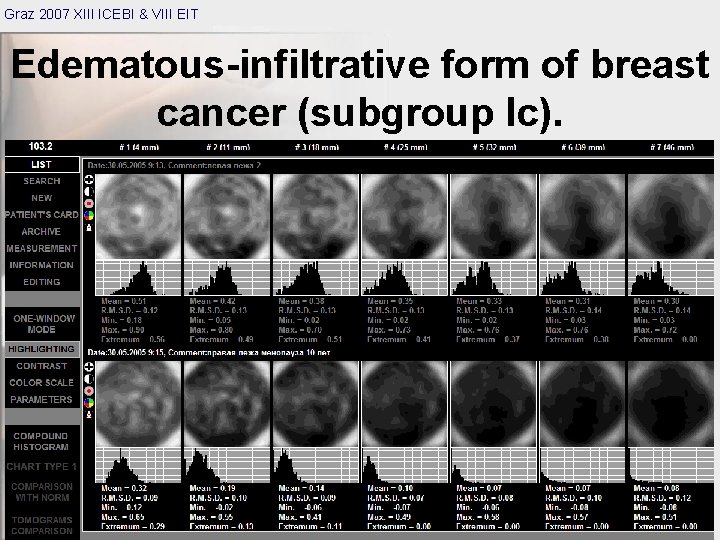 Graz 2007 XIII ICEBI & VIII EIT Edematous-infiltrative form of breast cancer (subgroup Ic).