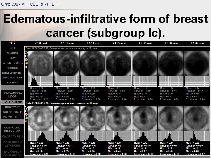 Graz 2007 XIII ICEBI & VIII EIT Edematous-infiltrative form of breast cancer (subgroup Ic).