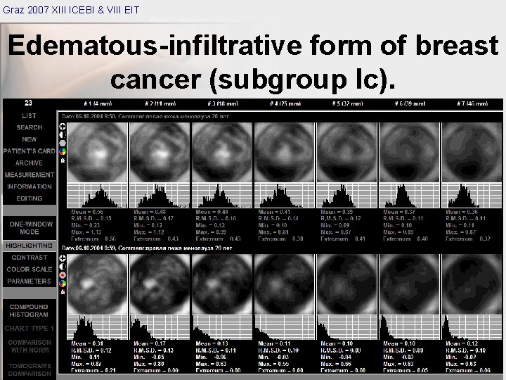 Graz 2007 XIII ICEBI & VIII EIT Edematous-infiltrative form of breast cancer (subgroup Ic).