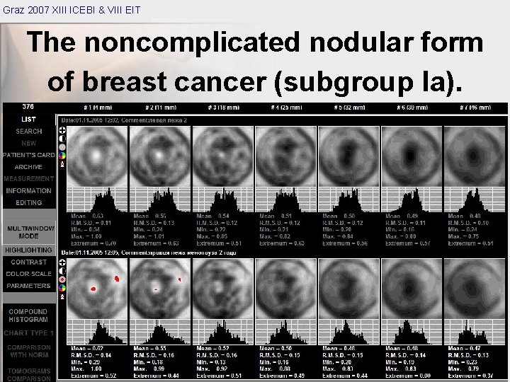Graz 2007 XIII ICEBI & VIII EIT The noncomplicated nodular form of breast cancer