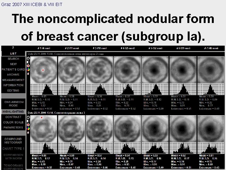 Graz 2007 XIII ICEBI & VIII EIT The noncomplicated nodular form of breast cancer