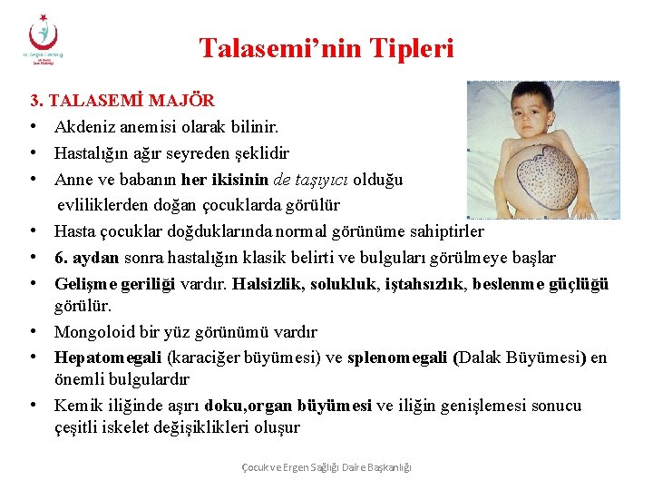 Talasemi’nin Tipleri 3. TALASEMİ MAJÖR • Akdeniz anemisi olarak bilinir. • Hastalığın ağır seyreden