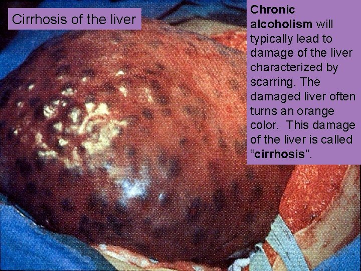 Cirrhosis of the liver Chronic alcoholism will typically lead to damage of the liver