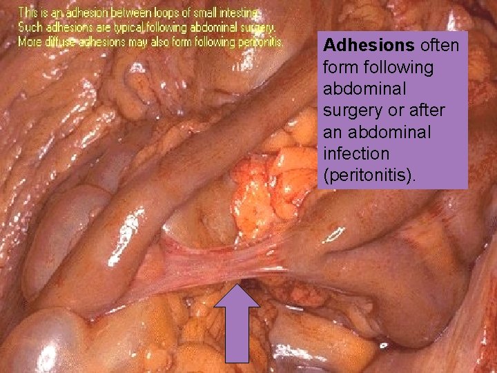 Adhesions often form following abdominal surgery or after an abdominal infection (peritonitis). 