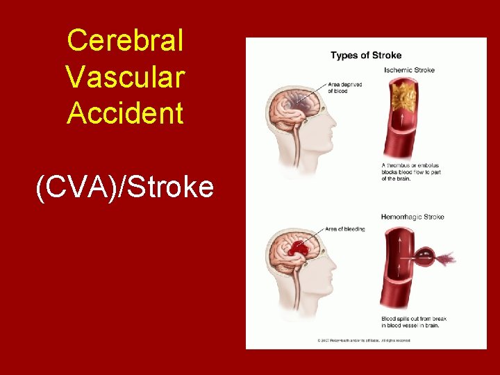 Cerebral Vascular Accident (CVA)/Stroke 
