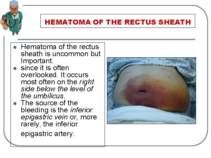 HEMATOMA OF THE RECTUS SHEATH l l l Hematoma of the rectus sheath is