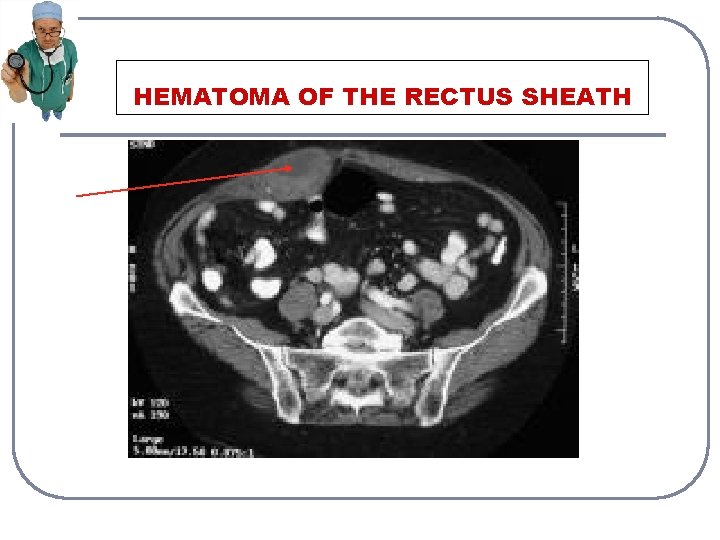 HEMATOMA OF THE RECTUS SHEATH 
