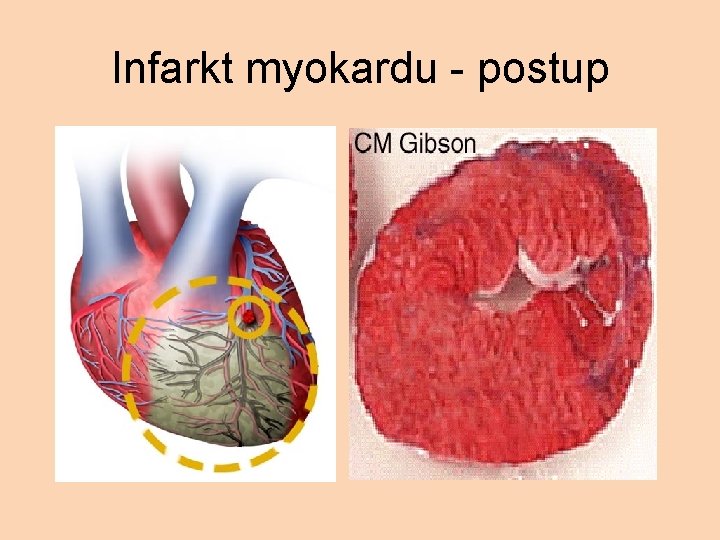 Infarkt myokardu - postup 