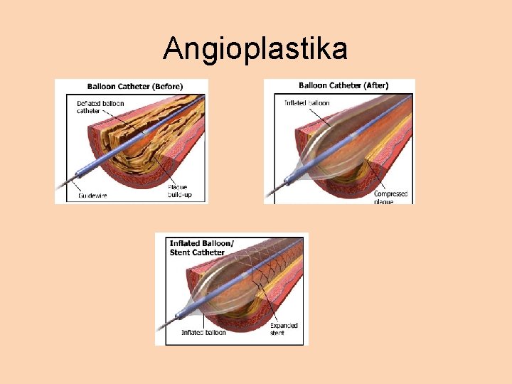 Angioplastika 