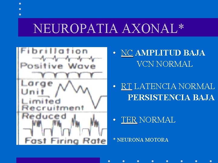 NEUROPATIA AXONAL* • NC AMPLITUD BAJA VCN NORMAL • RT LATENCIA NORMAL PERSISTENCIA BAJA