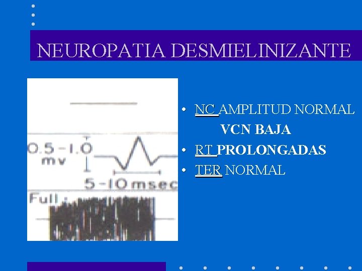 NEUROPATIA DESMIELINIZANTE • NC AMPLITUD NORMAL VCN BAJA • RT PROLONGADAS • TER NORMAL