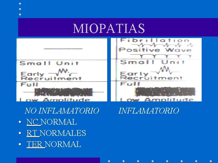 MIOPATIAS NO INFLAMATORIO • NC NORMAL • RT NORMALES • TER NORMAL INFLAMATORIO 