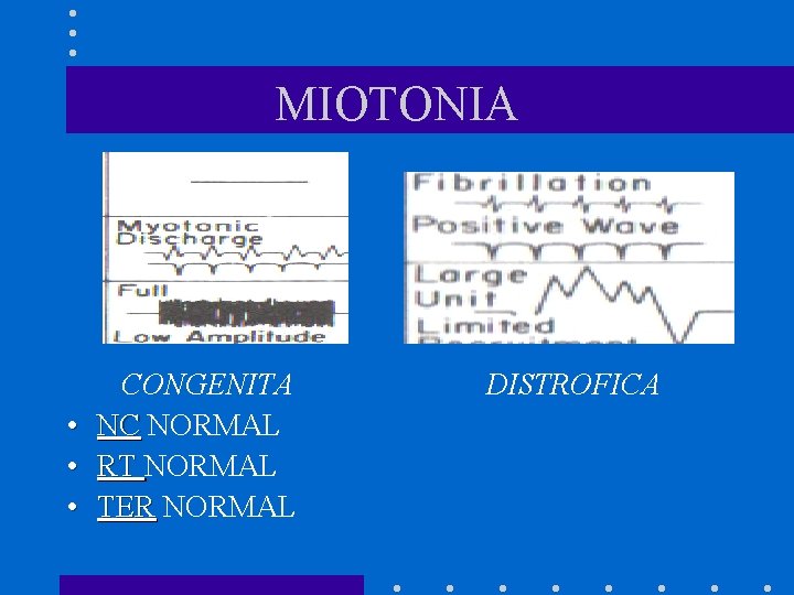 MIOTONIA • • • CONGENITA NC NORMAL RT NORMAL TER NORMAL DISTROFICA 